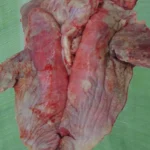 Viêm màng phổi có sợi huyết