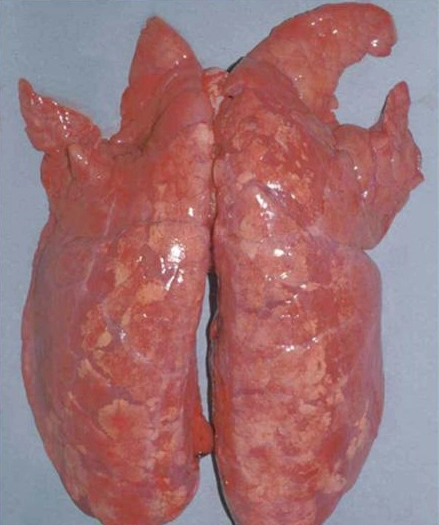 Viêm toàn bộ phổi