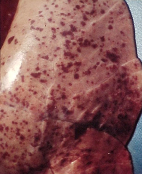 Xuất huyết điểm ở phổi bệnh phó thương hàn lợn